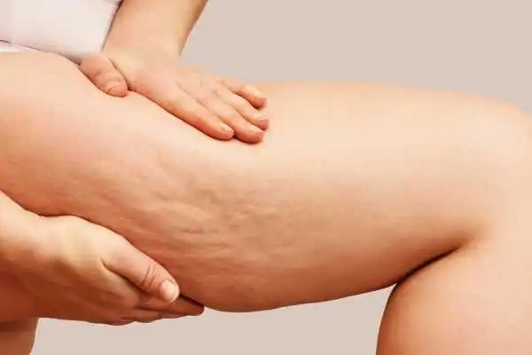 Image of woman showing leg with cellulite Abbotsbury