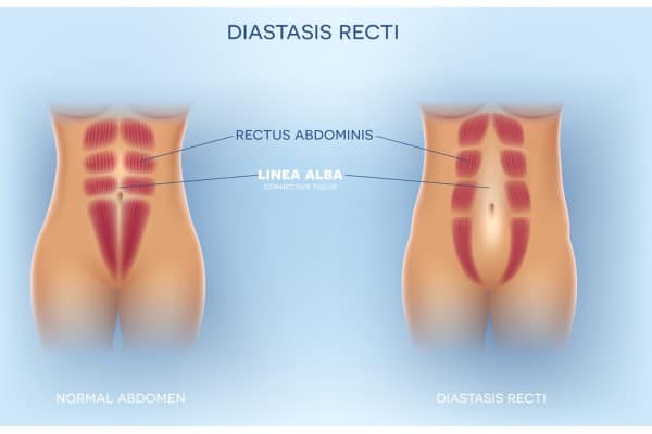 What Non-Surgical Options Are Available for Diastasis Recti Abbotsbury?