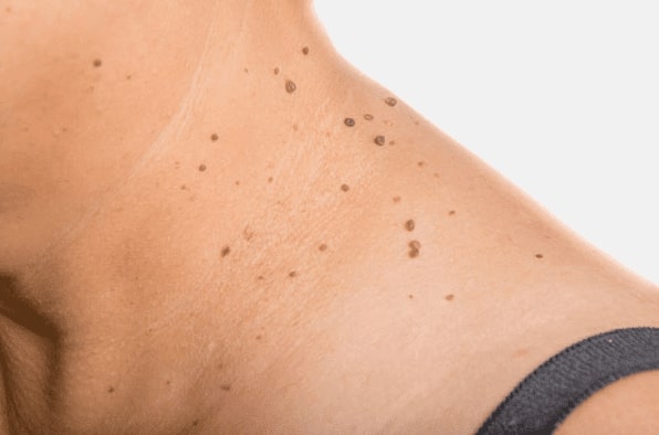 Are you looking for easy skin tag removal Abbotsbury - then contact Spire today!
