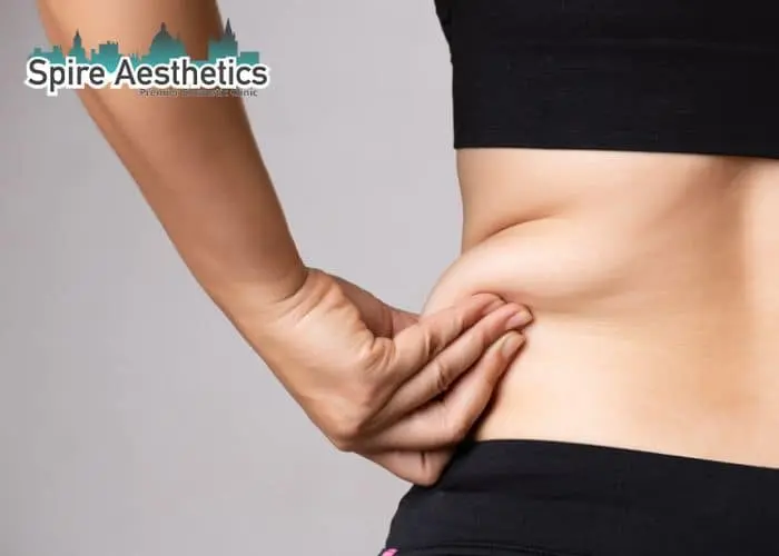 Image of woman pinching fat on their hips Abbotsbury. Fat Freezing treatment