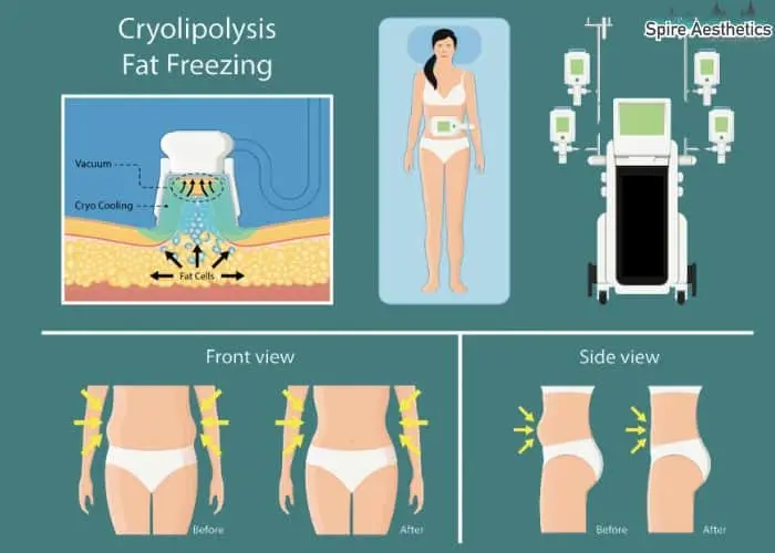 Fat freezing treatment Abbotsbury benefits for competitions to remove stubborn fat deposits.