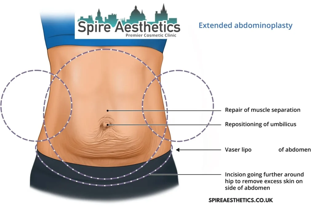 Understanding Loose Skin After Gastric Band Abbotsbury Surgery and HIFU Treatment