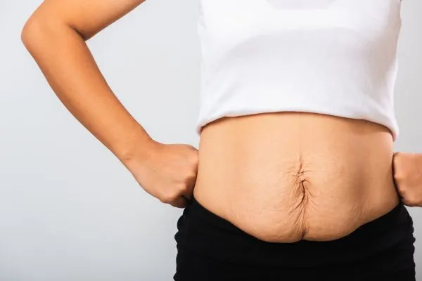 Image of a woman's stomach after weight loss with sagging skin following a gastric band Abbotsbury
