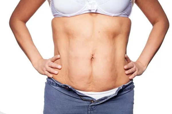 sagging skin on woman's stomach after weight loss injections Abbotsbury