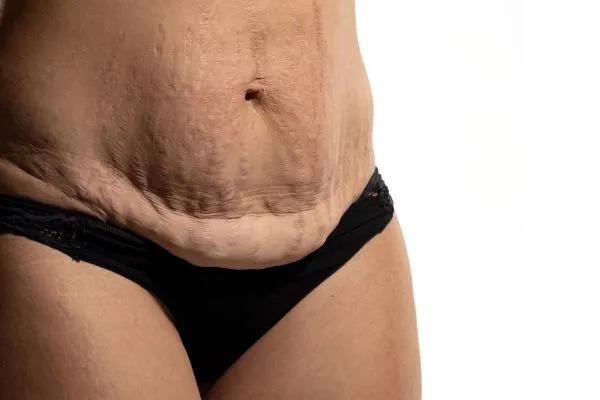 Image of womans stomach after weight loss injections Abbotsbury showing saggy skin