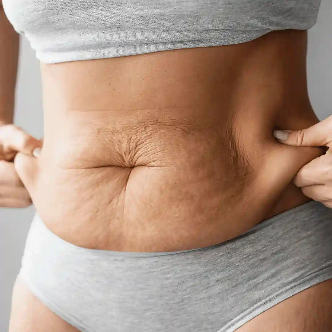 Is It Normal to Have Loose Skin After Pregnancy Abbotsbury?